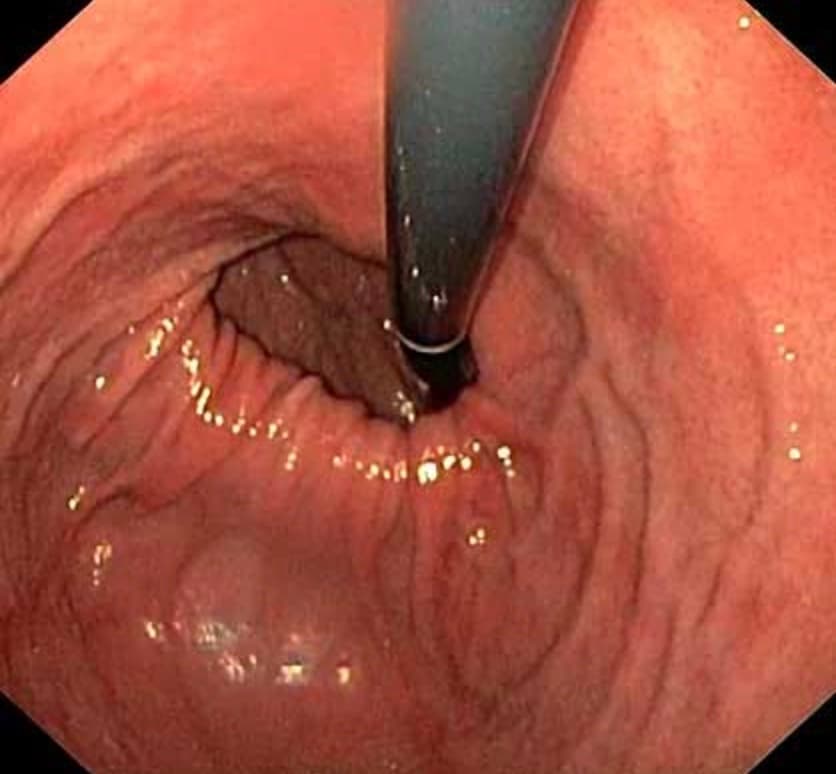Imagem de endoscopia digestiva alta — mucosa gástrica